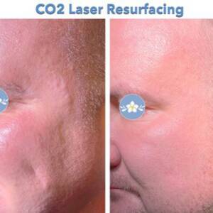 Co2 Laser 2 400x400