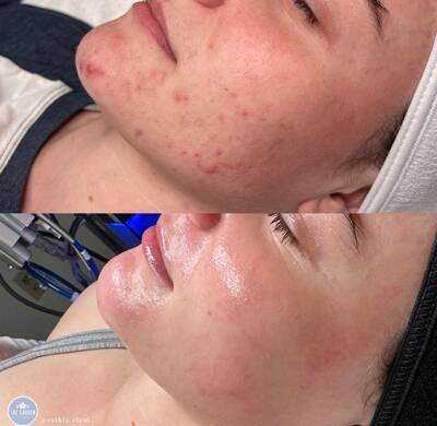 Chemical Peel 400x