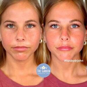 Dermal Lips 1 400x400