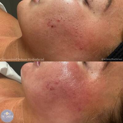 Hydra Facial 400x