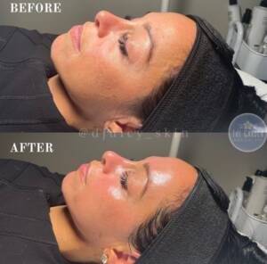 Hydra Facial 2 400x