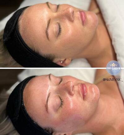 Hydra Facial 3 400x