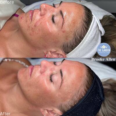 Hydra Facial 4 400x