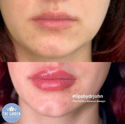 Lip Filler 1.png 400x400