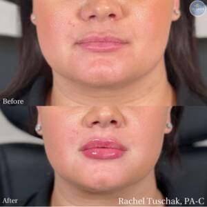 Lip Filler 2 400x400
