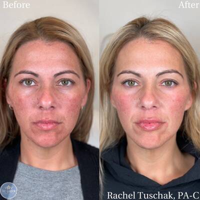 Full Face Rejuvenation 1.png 400x400