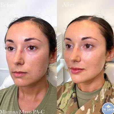 Full Face Rejuvenation 3 400x400