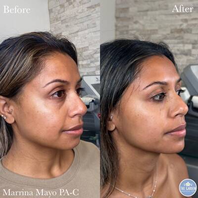 Full Face Rejuvenation 4 400x400